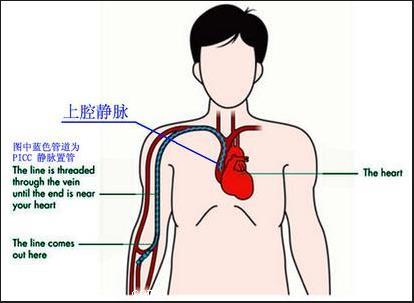 双腔静脉导管的分解图图片